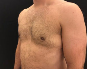 Gynecomastia