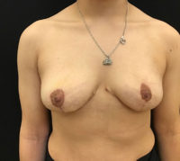 Breast Lift