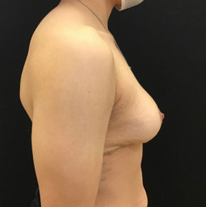 Breast Lift