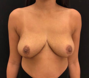 Breast Reduction