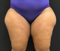 Liposuction