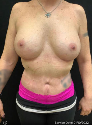 Breast Augmentation