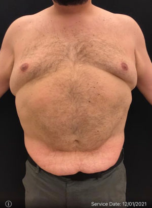 Liposuction