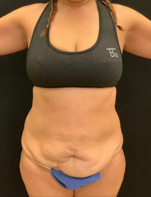 Tummy Tuck