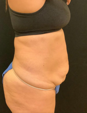 Tummy Tuck