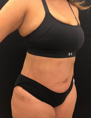 Tummy Tuck