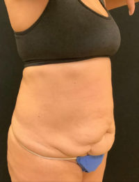 Tummy Tuck