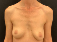 Breast Augmentation