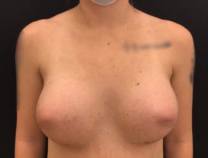 Breast Augmentation