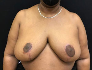 Breast Reduction