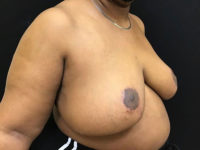 Breast Reduction