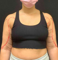 Liposuction