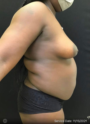 Liposuction
