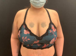 Liposuction