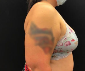 Liposuction