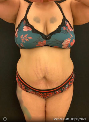 Liposuction