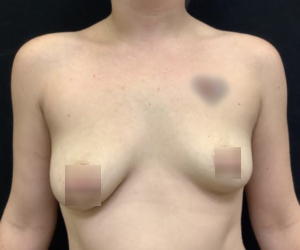 Breast Augmentation