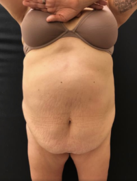 Tummy Tuck