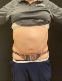 Tummy Tuck