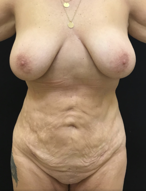 Liposuction