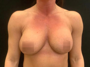 Breast Augmentation