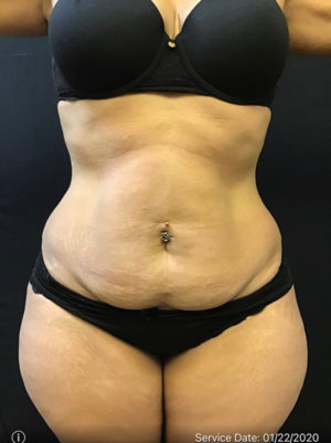 Tummy Tuck