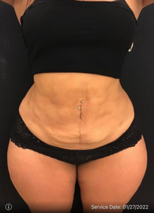 Tummy Tuck