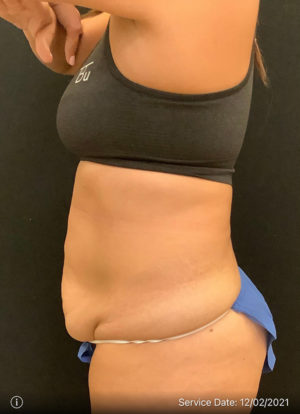 Tummy Tuck