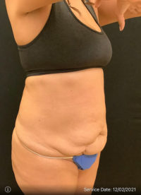 Tummy Tuck