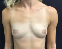 Breast Augmentation