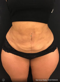 Liposuction