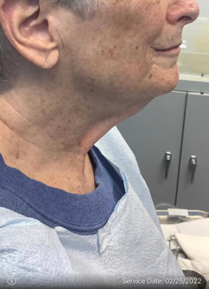 Neck Lift