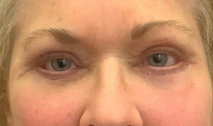 Eyelid Surgery