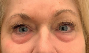 Eyelid Surgery