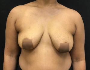 Breast Augmentation