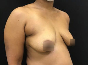 Breast Augmentation