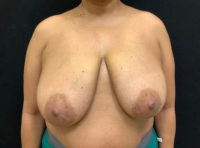 Breast Reduction