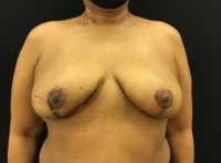 Breast Reduction