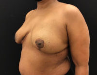 Breast Reduction