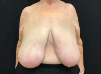 Breast Reduction