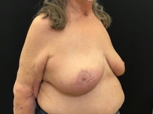 Breast Reduction