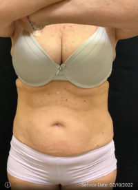 Liposuction