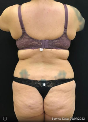 Liposuction