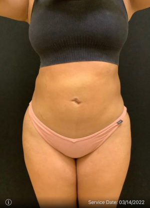 Liposuction