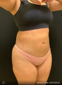 Liposuction