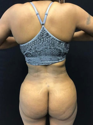 Brazilian Butt Lift