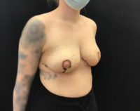 Breast Reduction