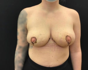 Breast Reduction