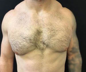 Gynecomastia