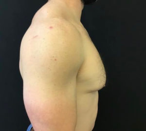 Gynecomastia